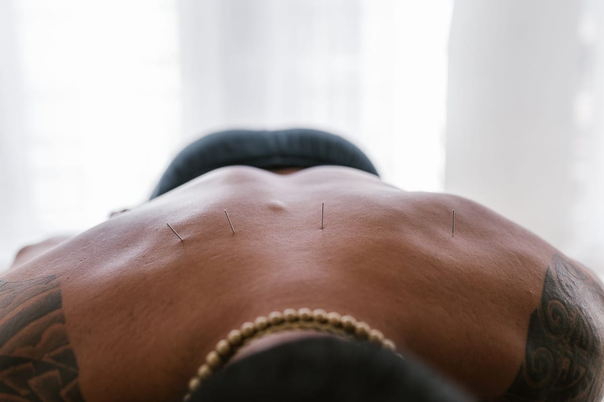 Fine acupuncture needles placed along a patient's back